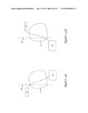 SUBCUTANEOUS DEFIBRILLATOR IMPLANTATION diagram and image