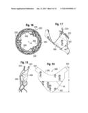 PROSTHETIC HEART VALVE HAVING IMPROVED COMMISSURE SUPPORTS diagram and image