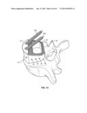 Implant with Sensor diagram and image