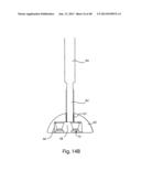 GLENOID VAULT FIXATION diagram and image