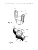 GLENOID VAULT FIXATION diagram and image