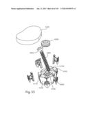 Shoulder Arthroplasty diagram and image