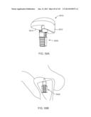 Shoulder Arthroplasty diagram and image