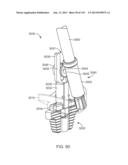 Shoulder Arthroplasty diagram and image