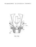 Shoulder Arthroplasty diagram and image