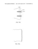 Shoulder Arthroplasty diagram and image