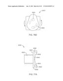 Shoulder Arthroplasty diagram and image