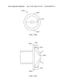 Shoulder Arthroplasty diagram and image