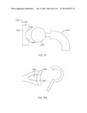 Shoulder Arthroplasty diagram and image