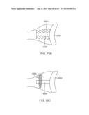 Shoulder Arthroplasty diagram and image