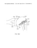 Shoulder Arthroplasty diagram and image