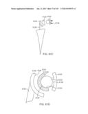 Shoulder Arthroplasty diagram and image