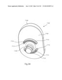 Shoulder Arthroplasty diagram and image