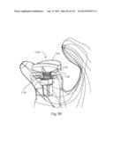 Shoulder Arthroplasty diagram and image