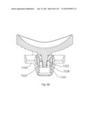 Shoulder Arthroplasty diagram and image