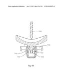 Shoulder Arthroplasty diagram and image