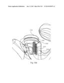 Shoulder Arthroplasty diagram and image