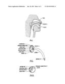Nasopharyngeal Trumpet with Inflatable Tip diagram and image