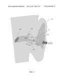 Blast Attenuating Earplug diagram and image