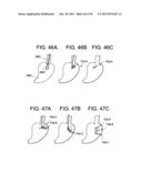 DEVICES AND METHODS FOR ENDOLUMINAL PLICATION diagram and image