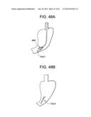 DEVICES AND METHODS FOR ENDOLUMINAL PLICATION diagram and image