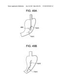 DEVICES AND METHODS FOR ENDOLUMINAL PLICATION diagram and image