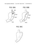 DEVICES AND METHODS FOR ENDOLUMINAL PLICATION diagram and image