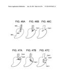 DEVICES AND METHODS FOR ENDOLUMINAL PLICATION diagram and image