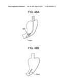 DEVICES AND METHODS FOR ENDOLUMINAL PLICATION diagram and image