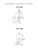 DEVICES AND METHODS FOR ENDOLUMINAL PLICATION diagram and image