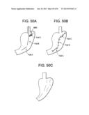 DEVICES AND METHODS FOR ENDOLUMINAL PLICATION diagram and image