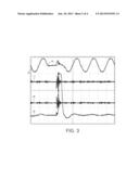 PROTECTING AGAINST TRANSIENTS IN A COMMUNICATION SYSTEM diagram and image