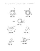 Dual Cannula System for Enteric Feeding diagram and image