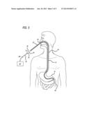 Dual Cannula System for Enteric Feeding diagram and image