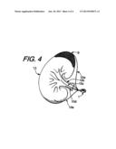 Subcutaneous Controlled Delivery System For The Topical Administration Of     Drugs, Biological Agents Or Therapeutic Agents To Targeted Areas Within     The Body diagram and image