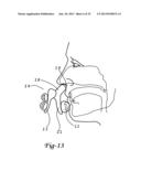 Intranasal Cartridge Devices diagram and image