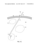 NEUROSURGICAL DEVICES AND ASSOCIATED SYSTEMS AND METHODS diagram and image