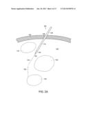 NEUROSURGICAL DEVICES AND ASSOCIATED SYSTEMS AND METHODS diagram and image