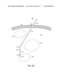 NEUROSURGICAL DEVICES AND ASSOCIATED SYSTEMS AND METHODS diagram and image