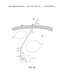 NEUROSURGICAL DEVICES AND ASSOCIATED SYSTEMS AND METHODS diagram and image