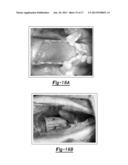 Porous Bidirectional Bellowed Tracheal Reconstruction Device diagram and image