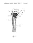 PROSTHETIC FEMORAL STEM FOR USE IN HIGH OFFSET HIP REPLACEMENT diagram and image