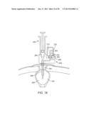 FLUID EXCHANGE APPARATUS AND METHODS diagram and image