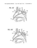 METHODS, DEVICES AND SYSTEMS FOR TREATING AND/OR DIAGNOSIS OF DISORDERS OF     THE EAR, NOSE AND THROAT diagram and image