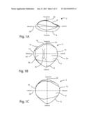 Patient Specific Implants and Instrumentation For Patellar Prostheses diagram and image