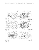 Patient Specific Implants and Instrumentation For Patellar Prostheses diagram and image