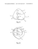 Patient Specific Implants and Instrumentation For Patellar Prostheses diagram and image