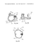 Patient Specific Implants and Instrumentation For Patellar Prostheses diagram and image