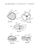 Patient Specific Implants and Instrumentation For Patellar Prostheses diagram and image