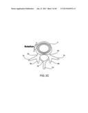 SYSTEMS AND METHODS FOR POSTERIOR DYNAMIC STABILIZATION OF THE SPINE diagram and image